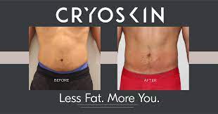 cryoslimming for cellulite by defy egypt